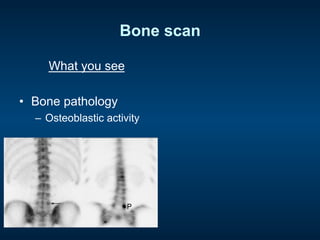 Bone scan
What you see
•  Bone pathology
–  Osteoblastic activity
 