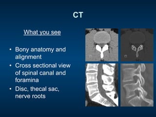 CT
What you see
•  Bony anatomy and
alignment
•  Cross sectional view
of spinal canal and
foramina
•  Disc, thecal sac,
nerve roots
 