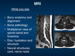 MRI
What you see
•  Bony anatomy and
alignment
•  Bone pathology
•  Multiplanar view of
spinal canal and
foramina
•  Disc: hydration and
structure
•  Neural structures:
cord, nerve roots
 