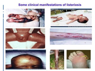 Listeria monocytogenes: An emerging foodborne pathogen in Ghana? 