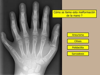 Cómo se llama esta malformación
          de la mano ?




             Aneurisma

               Cifosis

             Polidactilia

             Sarcoidosis
 