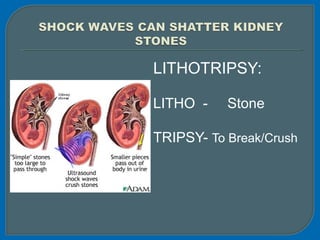 LITHOTRIPSY:
LITHO - Stone
TRIPSY- To Break/Crush
 