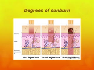 Degrees of sunburn
 