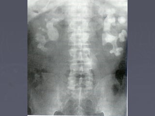 Litiaisis renal epidemio 2