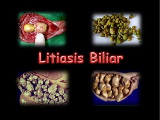 Litiasis