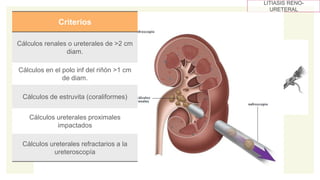 Nefrolitotomía Percutánea (NLP):
tasa de éxito de aproximadamente del 70-85%.
LITIASIS RENO-
URETERAL
Criterios
Cálculos renales o ureterales de >2 cm
diam.
Cálculos en el polo inf del riñón >1 cm
de diam.
Cálculos de estruvita (coraliformes)
Cálculos ureterales proximales
impactados
Cálculos ureterales refractarios a la
ureteroscopía
 