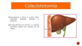 Colecistotomía
 Descomprime y drena la vesícula biliar
distendida, inflamada, hidrópica o
purulenta.
 El procedimiento de elección es el drenaje
percutáneo guiado por ecografía con un
catéter
 