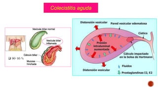 Colecistitis aguda
 90- 95 %
 