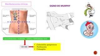 Manifestaciones clínicas
Leucocitosis leve- moderada : 12000 a 15000células/ mm3
>20 000
• Colecistitis gangrenosa
• Perforación
• Colangitis
 