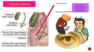 Coledocolitiasis • Asintomáticos
• Síntomas
o Colangitis
o Pancreatitis
o Piocolecisto
o Perforación
 