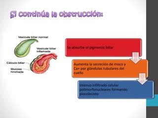 Litiasis biliar, colico biliar, colecistitis aguda | PPTX