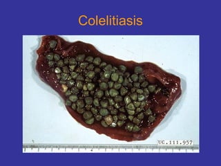 Colelitiasis 