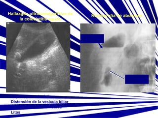 Hallazgos ultrasonográficos de
la colecistitis aguda

Radiografía de abdomen

Nivel
hidroaéreo

Gas entre la
pared
vesicular

Liquido pericolecístico
Distensión de la vesícula biliar
Pared vesicular edematosa
Litos

 