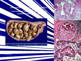 VESICULA BILIAR CON COLECISTITIS CRONICA,
COLELITIASIS
Y UN PEQUEÑO TUMOR PAPILAR A NIVEL DEL
CONDUCTO CISTICO (macro)

Adenocarcinoma Papilar de la Vesícula Biliar
(micro)

 
