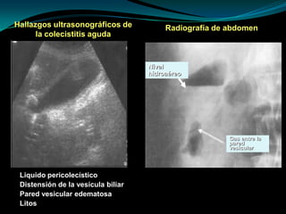 Hallazgos ultrasonográficos de
la colecistitis aguda
Liquido pericolecístico
Distensión de la vesícula biliar
Pared vesicular edematosa
Litos
Radiografía de abdomen
Nivel
hidroaéreo
Gas entre la
pared
vesicular
 
