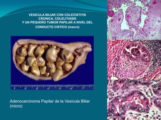 VESICULA BILIAR CON COLECISTITIS
CRONICA, COLELITIASIS
Y UN PEQUEÑO TUMOR PAPILAR A NIVEL DEL
CONDUCTO CISTICO (macro)
Adenocarcinoma Papilar de la Vesícula Biliar
(micro)
 