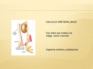 CALCULO URETERAL BAJO
Con dolor que irradia a la
vejiga, vulva o escroto
Urgencia urinaria y poliaquiuria
 
