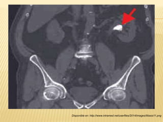 Disponible en: http://www.intramed.net/userfiles/2014/images/litiasis11.png
 