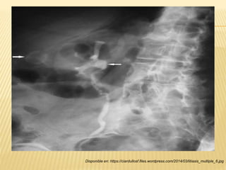Disponible en: https://ciardullosf.files.wordpress.com/2014/03/litiasis_multiple_6.jpg
 