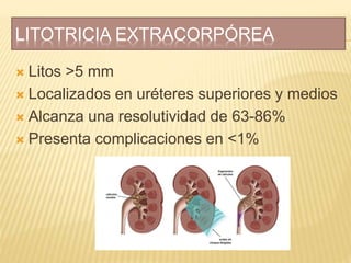 LITOTRICIA EXTRACORPÓREA
 Litos >5 mm
 Localizados en uréteres superiores y medios
 Alcanza una resolutividad de 63-86%
 Presenta complicaciones en <1%
 