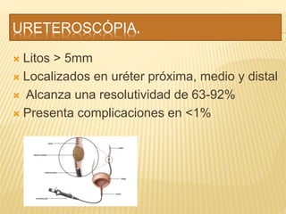 URETEROSCÓPIA.
 Litos > 5mm
 Localizados en uréter próxima, medio y distal
 Alcanza una resolutividad de 63-92%
 Presenta complicaciones en <1%
 