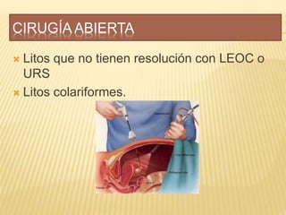 CIRUGÍA ABIERTA
 Litos que no tienen resolución con LEOC o
URS
 Litos colariformes.
 