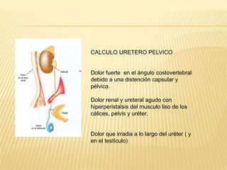 CALCULO URETERO PELVICO
Dolor fuerte en el ángulo costovertebral
debido a una distención capsular y
pélvica.
Dolor renal y ureteral agudo con
hiperperistalsis del musculo liso de los
cálices, pelvis y uréter.
Dolor que irradia a lo largo del uréter ( y
en el testículo)
 