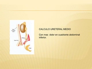 CALCULO URETERAL MEDIO
Con mas dolor en cuadrante abdominal
inferior.
 