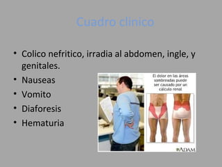 Cuadro clinico
• Colico nefritico, irradia al abdomen, ingle, y
genitales.
• Nauseas
• Vomito
• Diaforesis
• Hematuria
 