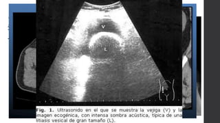 Litiasis
Vesical:
TAC
 