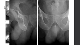 Litiasis Prostática:
• Concreciones que se formaron en un principio en el espesor del tejido prostático,
suelen ser numerosos y relativamente pequeños, de 1 a 10 mm de diámetro y la
mayoría se producen en varones de 50 a 65 años de edad.
• Pueden formarse en la fosa prostática y ser secundarios a infección u obstrucción,
o pueden ser cálculos originados en otra región del aparato urinario y son
alojados en la uretra prostática.
 