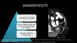 DIAGNÓSTICO/TC
S: 94-100% y E: 92-100%
Muestra todos los litos, con
la excepción de la litiasis
por indinavir.
Densidad uniforme,
hiperdensos.
13
New and Evolving Concepts in the Imaging and Management of Urolithiasis: Urologists’ Perspective. Avinash R. Kambadakone, Brian H. Eisner, Onofrio Antonio Catalano, Dushyant V.
Sahani. Radiographics. 2010. 30: 603-623.
Traba Villameytide, Mª L., & Fernández-Guerrero, M.. (2004). Litiasis renal inducida por Indinavir. Actas Urológicas Españolas, 28(7), 523-526.
 
