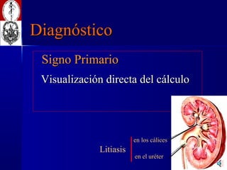 Diagnóstico ,[object Object],[object Object],en los cálices en el uréter Litiasis 