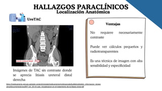 HALLAZGOS PARACLÍNICOS
https://medicaments.gencat.cat/web/.content/minisite/medicaments/professionals/butlletins/boletin_informacion_terape
utica/documents/arxius/BIT-vol_29-n4-cast_Actualizacion-en-el-tratamiento-de-la-litiasis-renal.pdf
Localización Anatómica
Imágenes de TAC sin contraste donde
se aprecia litiasis ureteral distal
derecha
UroTAC
Ventajas
No requiere necesariamente
contraste
Puede ver cálculos pequeños y
radiotransparentes
Es una técnica de imagen con alta
sensibilidad y especificidad
 