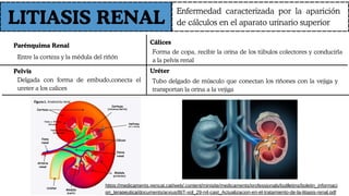 Entre la corteza y la médula del riñón
LITIASIS RENAL
Enfermedad caracterizada por la aparición
de cálculos en el aparato urinario superior
Parénquima Renal
Cálices
Pelvis
Forma de copa, recibir la orina de los túbulos colectores y conducirla
a la pelvis renal
Uréter
Delgada con forma de embudo,conecta el
ureter a los calices
Tubo delgado de músculo que conectan los riñones con la vejiga y
transportan la orina a la vejiga
https://medicaments.gencat.cat/web/.content/minisite/medicaments/professionals/butlletins/boletin_informaci
on_terapeutica/documents/arxius/BIT-vol_29-n4-cast_Actualizacion-en-el-tratamiento-de-la-litiasis-renal.pdf
 