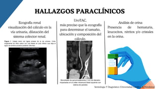 Análisis de orina
Presencia de hematuria,
leucocitos, nitritos y/o cristales
en la orina.
Ecografía renal
visualización del cálculo en la
vía urinaria, dilatación del
sistema colector renal.
UroTAC.
más preciso que la ecografía
para determinar el tamaño,
ubicación y composición del
cálculo.
HALLAZGOS PARACLÍNICOS
Semiologia Y Diagnóstico (Universidad Católica de Honduras)
Microlitiasis de aproximadamente 2 mm de diámetro
impactadas en el uréter intramural distal izquierdo con
edema de paredes
 