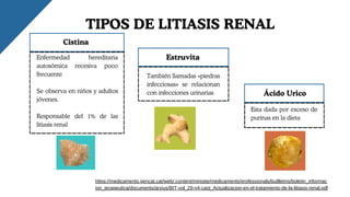 Enfermedad hereditaria
autosómica recesiva poco
frecuente
Se observa en niños y adultos
jóvenes.
Responsable del 1% de las
litiasis renal
Ácido Urico
También llamadas «piedras
infecciosas» se relacionan
con infecciones urinarias
Esta dada por exceso de
purinas en la dieta
TIPOS DE LITIASIS RENAL
https://medicaments.gencat.cat/web/.content/minisite/medicaments/professionals/butlletins/boletin_informac
ion_terapeutica/documents/arxius/BIT-vol_29-n4-cast_Actualizacion-en-el-tratamiento-de-la-litiasis-renal.pdf
Cistina
Estruvita
 
