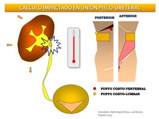 CALCULO IMPACTADO EN UNION PIELO-URETERAL
ANTERIOR
POSTERIOR
PUNTO COSTO-VERTEBRAL
PUNTO COSTO-LUMBAR
Avendaño. NefrologíaClínica. 2a Edición,
España 2003
 