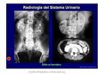Avendaño. NefrologíaClínica. 2a Edición, España 2003
 