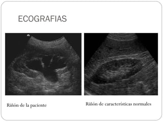 ECOGRAFIAS  Riñón de características normales Riñón de la paciente 