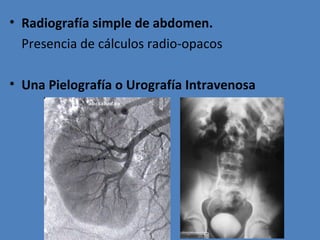• Radiografía simple de abdomen.
  Presencia de cálculos radio-opacos

• Una Pielografía o Urografía Intravenosa
 