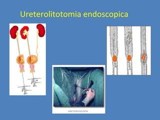 Ureterolitotomia endoscopica
 