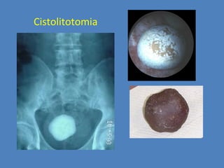 Cistolitotomia
 