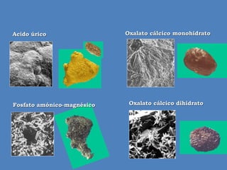 Acido úrico                 Oxalato cálcico monohidrato




Fosfato amónico-magnésico    Oxalato cálcico dihidrato
 