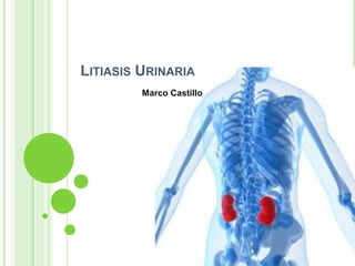 LITIASIS URINARIA
Marco Castillo
 
