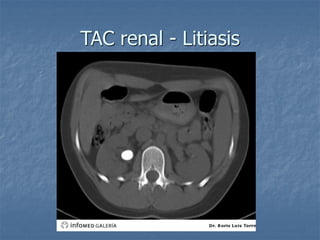 TAC renal - Litiasis
 