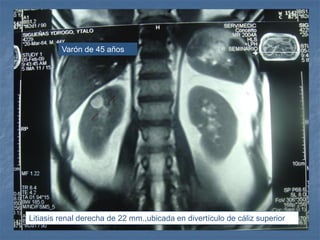 Litiasis renal derecha de 22 mm.,ubicada en divertículo de cáliz superior
Varón de 45 años
 