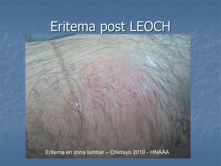 Eritema post LEOCH
Eritema en zona lumbar – Chiclayo 2010 - HNAAA
 