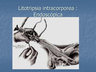 Litotripsia intracorporea :
Endoscópica
 
