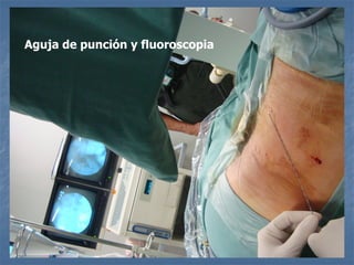 Aguja de punción y fluoroscopia
 